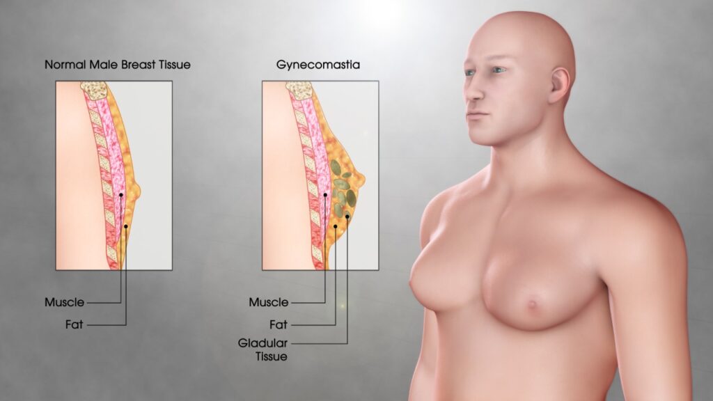 Gynecomastia vs Chest fat