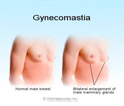 Gynecomastia vs Chest fat
