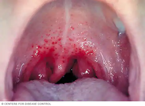 Oral Gonorrhea vs Strep Throat