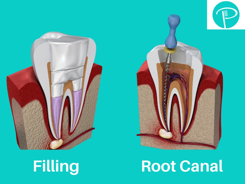Cavity vs root canal