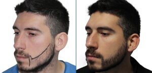 beard transplant before and after